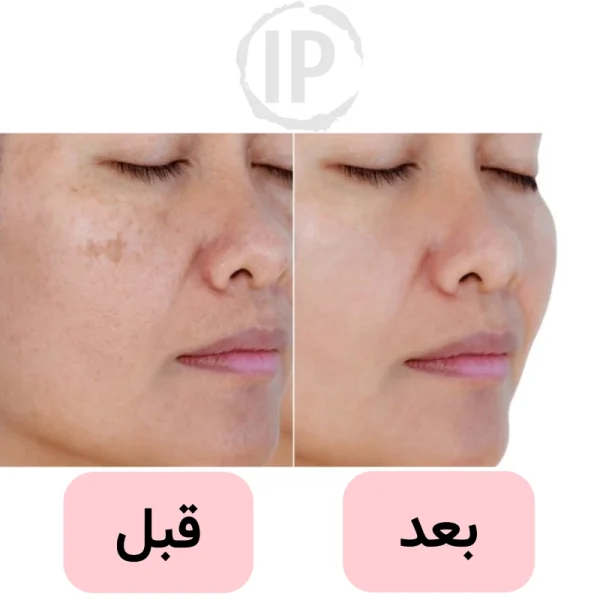 قبل و بعد استفاده از کرم سفید کننده صورت و نواحی تیره زنیکس 70 میل